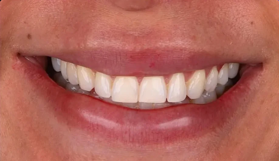 Composite bonding before photo, upper front teeth, case 8