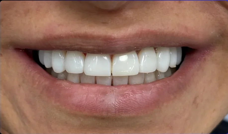Composite bonding after photo, upper front teeth, case 9