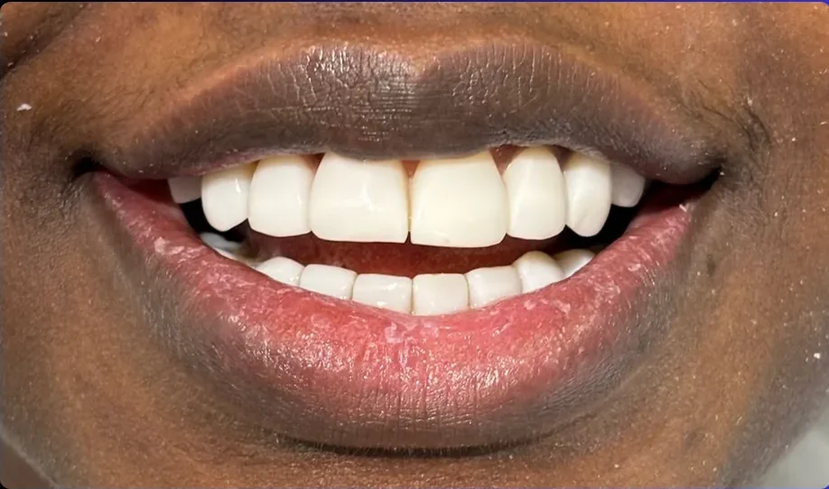 Composite bonding after photo, upper front teeth, case 12