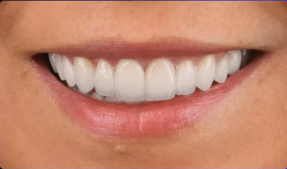 Composite bonding after photo, upper front teeth, case 14