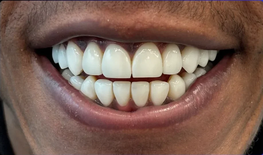 Composite bonding after photo, upper front teeth, case 15