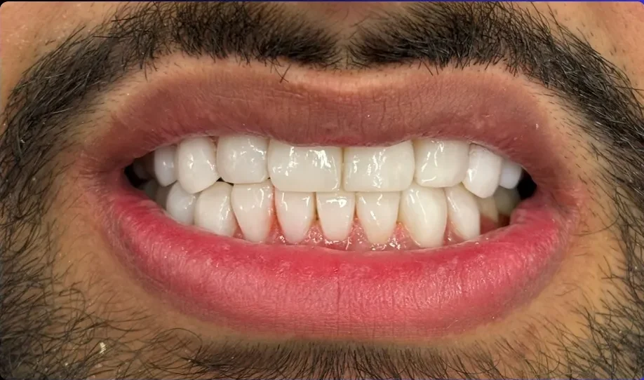 Composite bonding after photo, upper front teeth, case 18