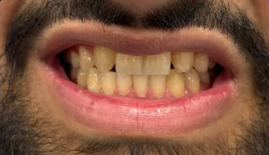 Composite bonding before photo, upper front teeth, case 18