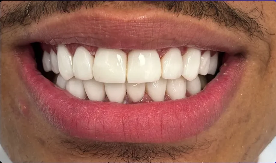 Composite bonding after photo, upper front teeth, case 21