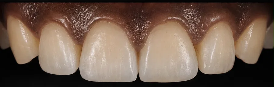 Composite bonding after photo, upper front teeth, case 22
