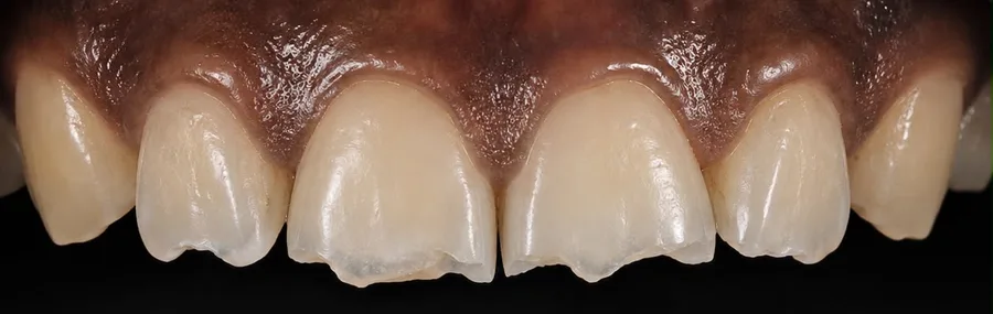 Composite bonding before photo, upper front teeth, case 22