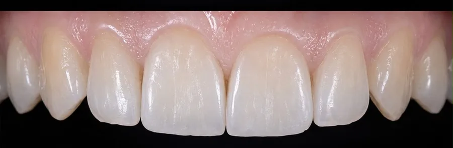 Composite bonding after photo, upper front teeth, case 23