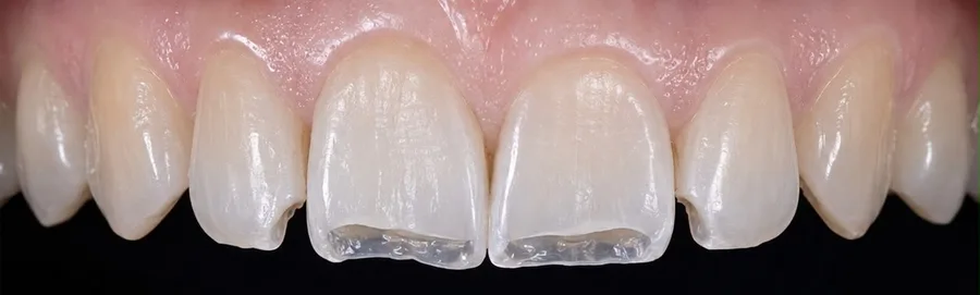 Composite bonding before photo, upper front teeth, case 23