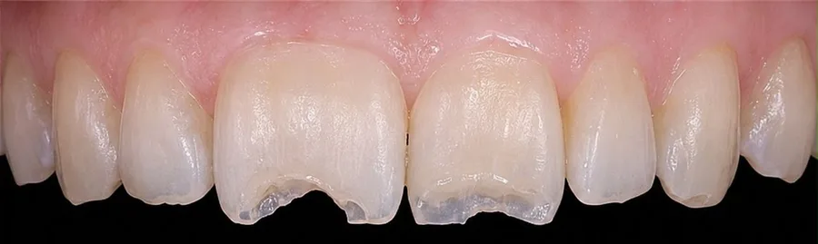Composite bonding before photo, upper front teeth, case 24