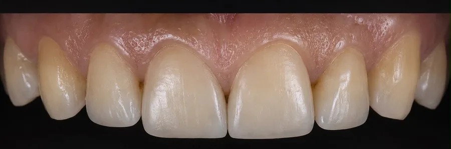 Composite bonding after photo, upper front teeth, case 25