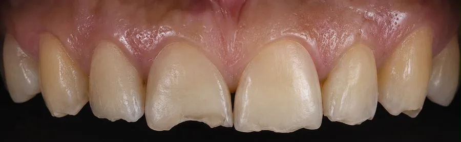 Composite bonding before photo, upper front teeth, case 25