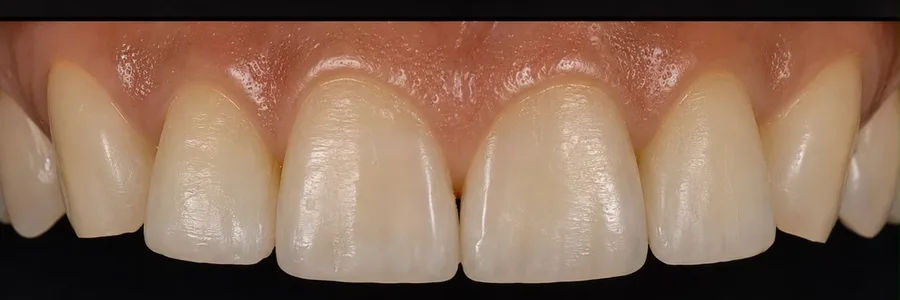 Composite bonding after photo, upper front teeth, case 26