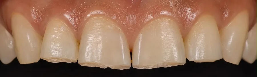 Composite bonding before photo, upper front teeth, case 26