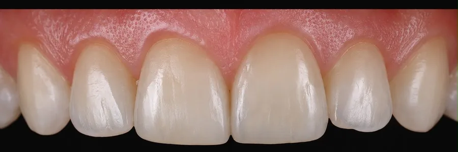 Composite bonding after photo, upper front teeth, case 27