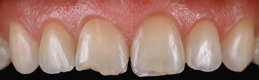 Composite bonding before photo, upper front teeth, case 27