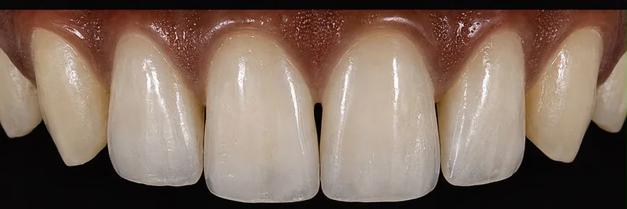 Composite bonding after photo, upper front teeth, case 28