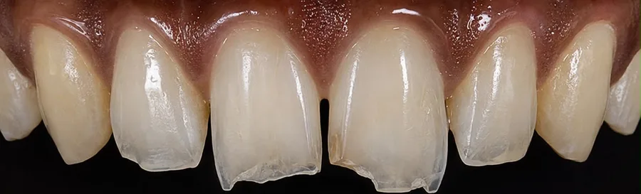 Composite bonding before photo, upper front teeth, case 28