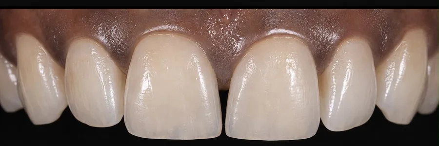 Composite bonding after photo, upper front teeth, case 29