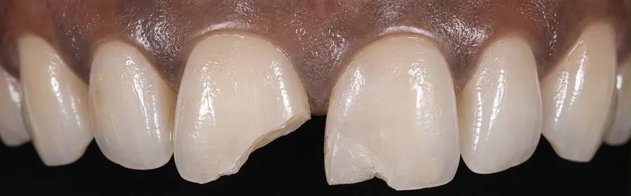 Composite bonding before photo, upper front teeth, case 29