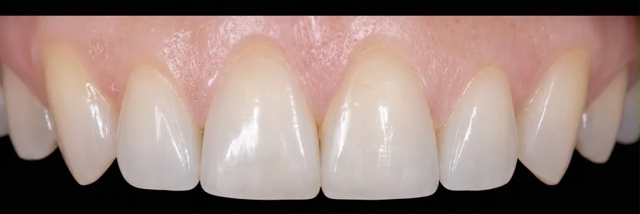 Composite bonding after photo, upper front teeth, case 30