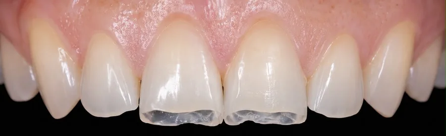 Composite bonding before photo, upper front teeth, case 30
