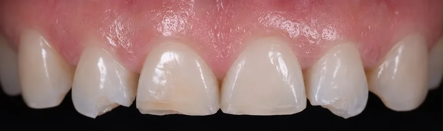 Composite bonding before photo, upper front teeth, case 31