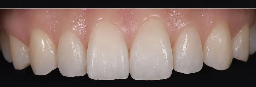 Composite bonding after photo, upper front teeth, case 32