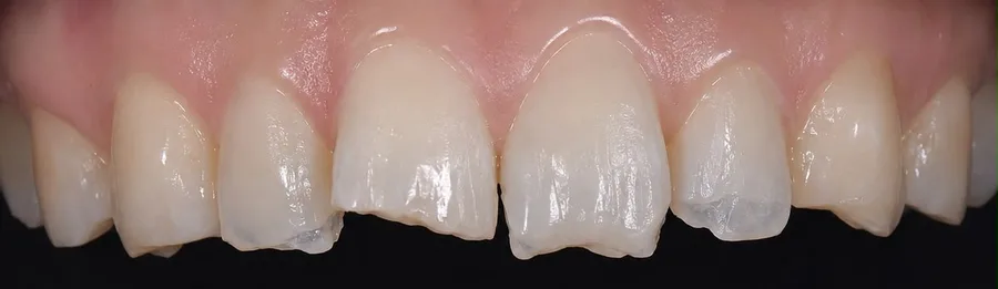 Composite bonding before photo, upper front teeth, case 32