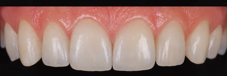 Composite bonding after photo, upper front teeth, case 33