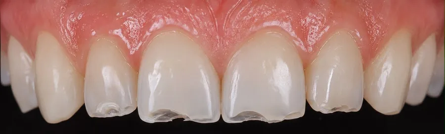 Composite bonding before photo, upper front teeth, case 33