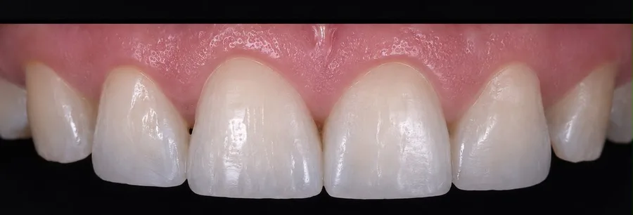 Composite bonding after photo, upper front teeth, case 34