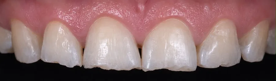 Composite bonding before photo, upper front teeth, case 34