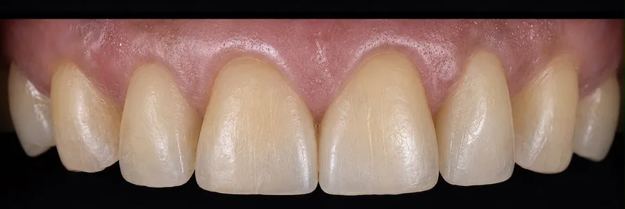 Composite bonding after photo, upper front teeth, case 35
