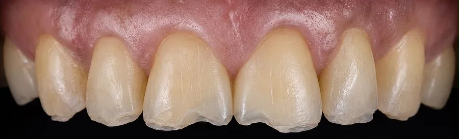 Composite bonding before photo, upper front teeth, case 35