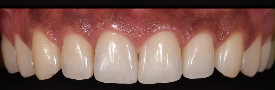 Composite bonding after photo, upper front teeth, case 36