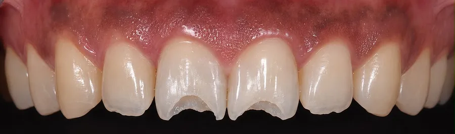 Composite bonding before photo, upper front teeth, case 36