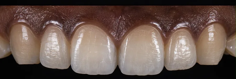 Composite bonding after photo, upper front teeth, case 37
