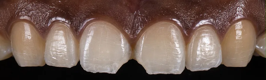 Composite bonding before photo, upper front teeth, case 37