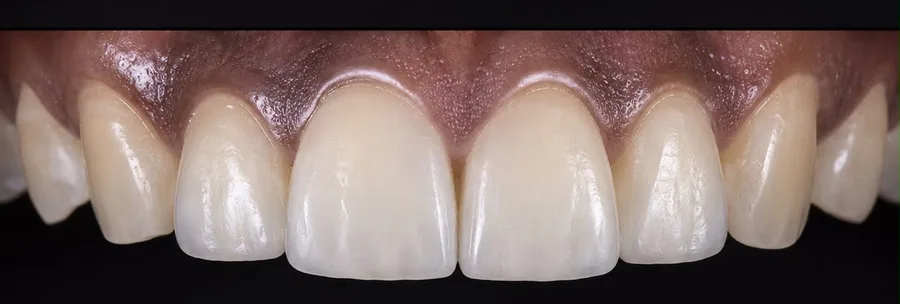 Composite bonding after photo, upper front teeth, case 39