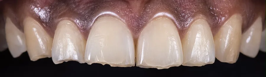 Composite bonding before photo, upper front teeth, case 39