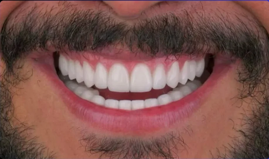 Composite bonding after photo, upper front teeth, case 7