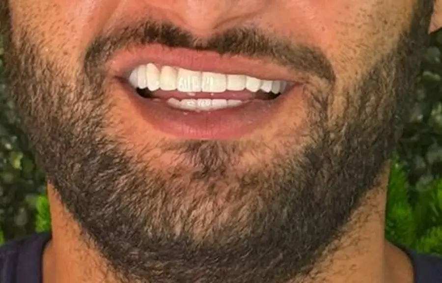 E.max crown case after treatment, front teeth, DentVisit patient