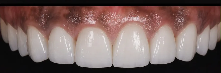 Porcelain veneer after photo, upper front teeth, case 1