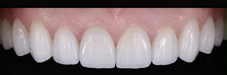 Porcelain veneer after photo, upper front teeth, case 2