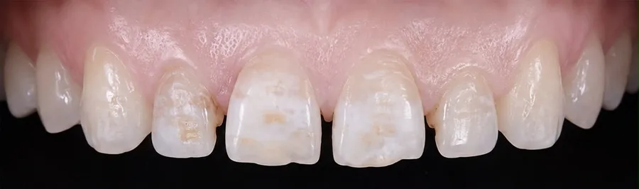 Porcelain veneer before photo, upper front teeth, case 2