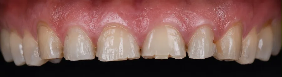 Porcelain veneer before photo, upper front teeth, case 4