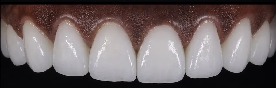 Porcelain veneer after photo, upper front teeth, case 5