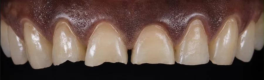 Porcelain veneer before photo, upper front teeth, case 5