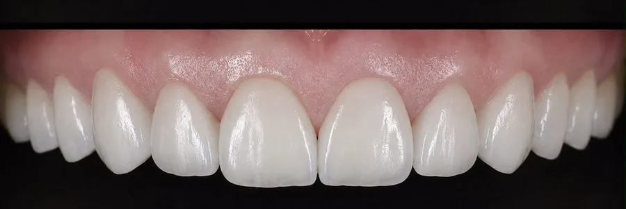 Porcelain veneer after photo, upper front teeth, case 6