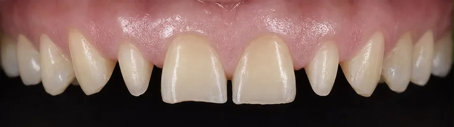 Porcelain veneer before photo, upper front teeth, case 6